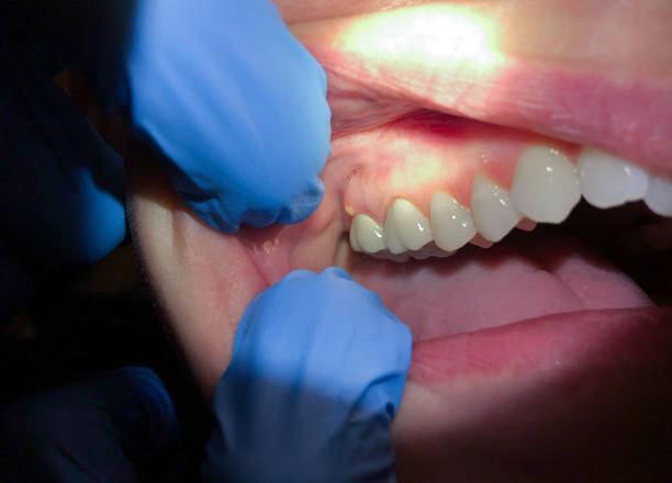Best Emergency Treatment for Dental Infections or Abscesses in Villa Hills, KY