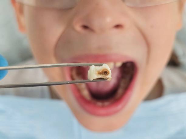 Best Emergency Tooth Extraction in Villa Hills, KY